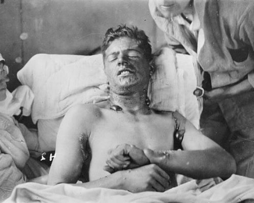 Verletzungen von Giftgas im Ersten Weltkrieg